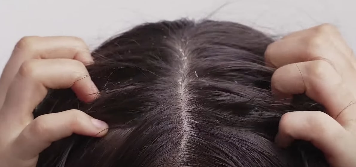 Girl scratching her hair due to scabs on her scalp