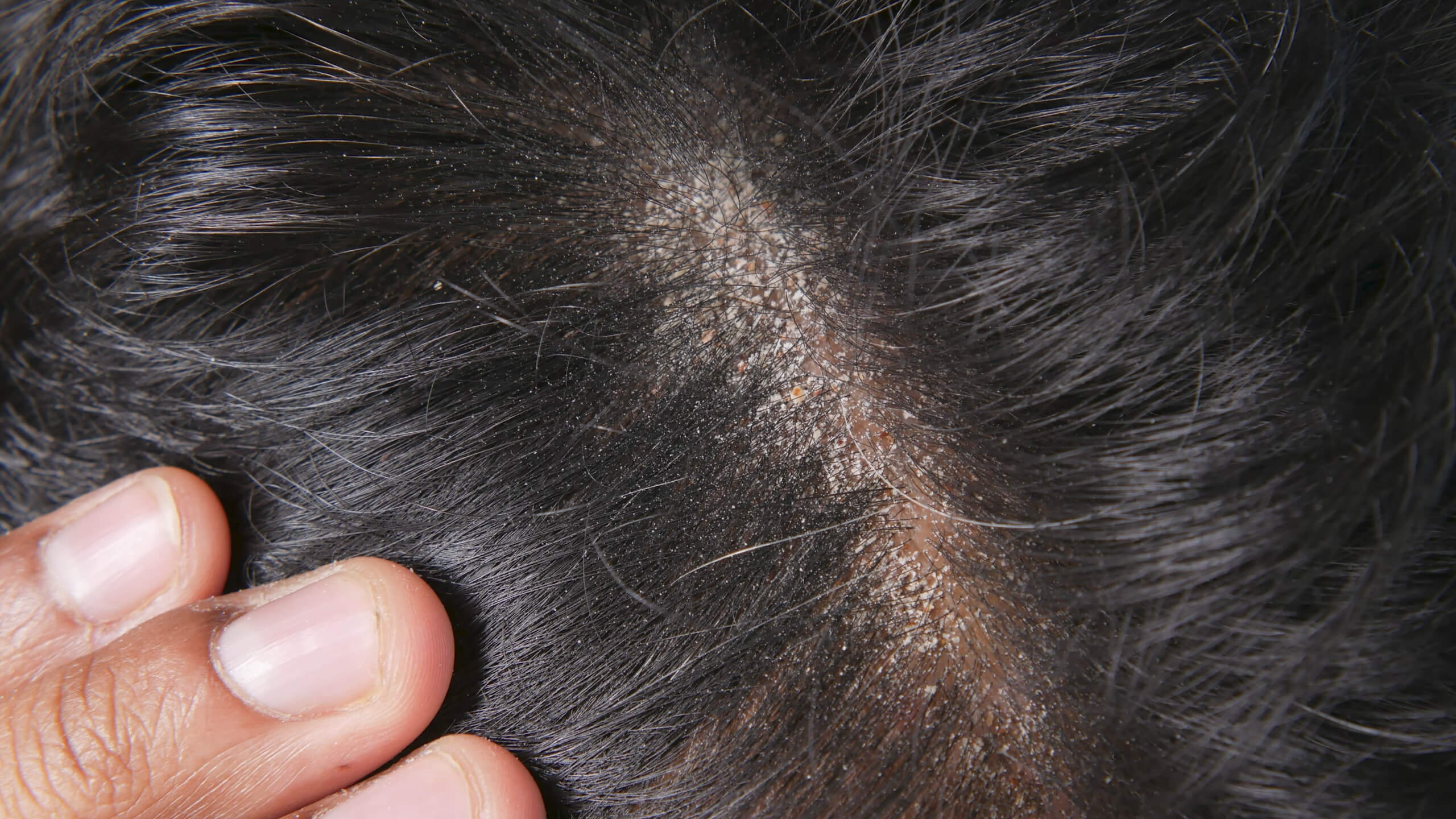 Man with seborrheic dermatitis on his scalp