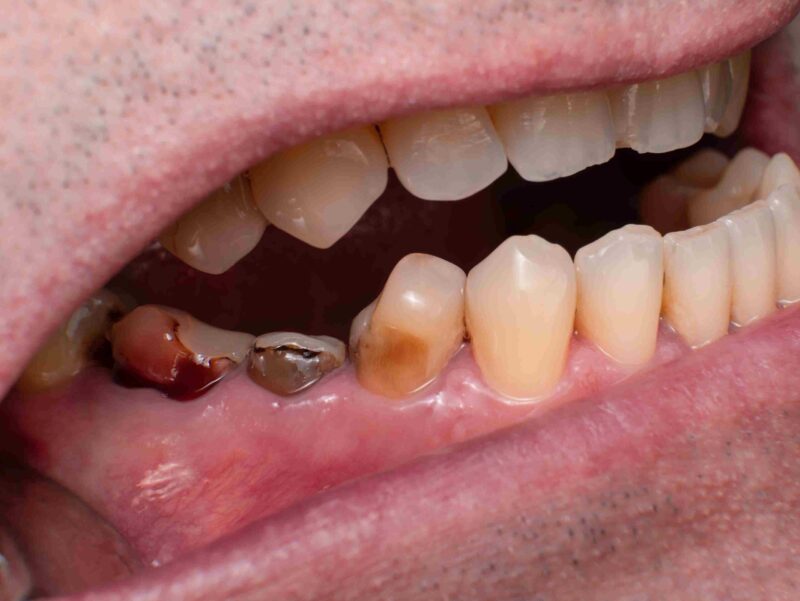 Close-up of damaged and decayed teeth with visible cracking and missing tooth structure